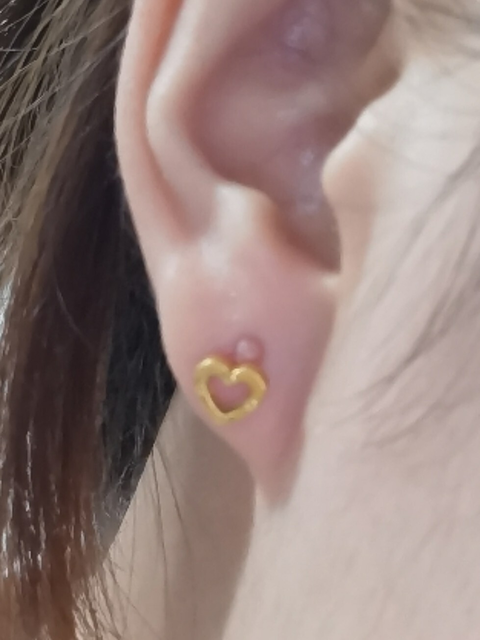 耳朵里长脓包是怎么回事