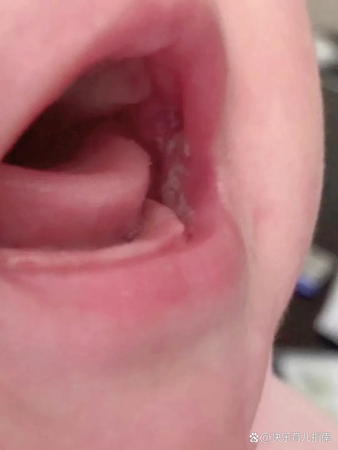 宝宝长鹅口疮怎么办