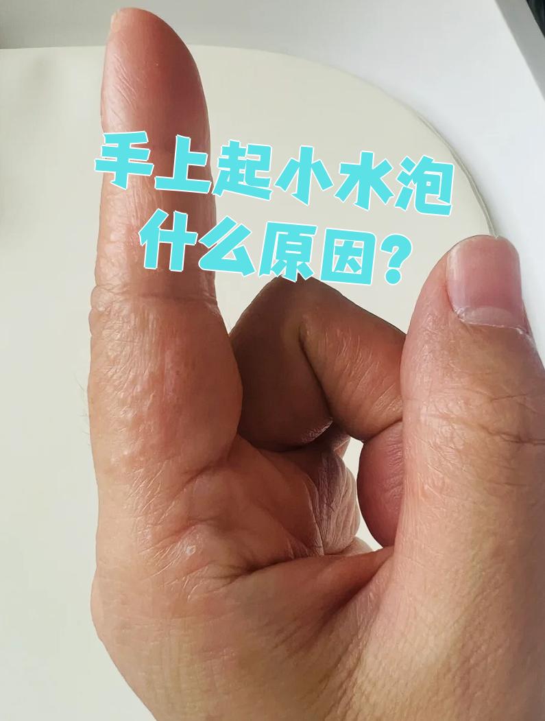 手上长了很多小水泡怎么治疗