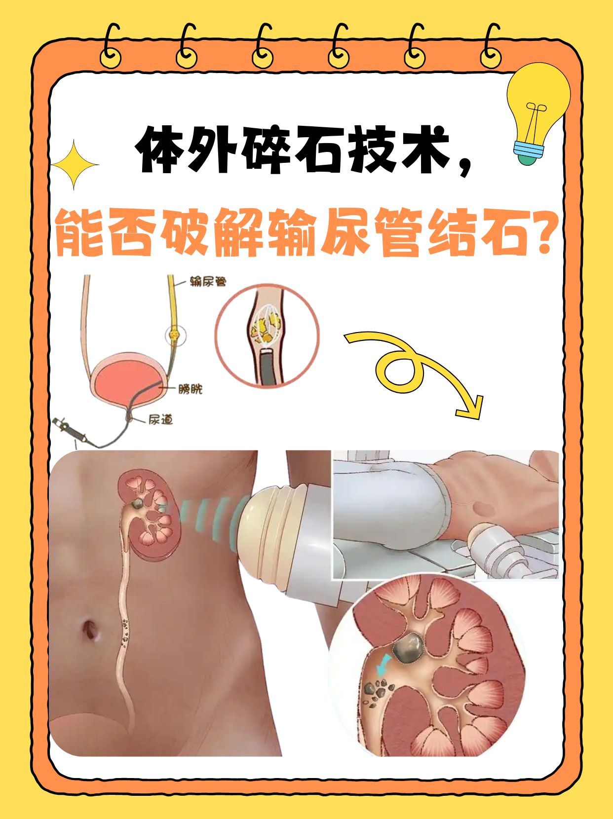 结石是怎么形成的