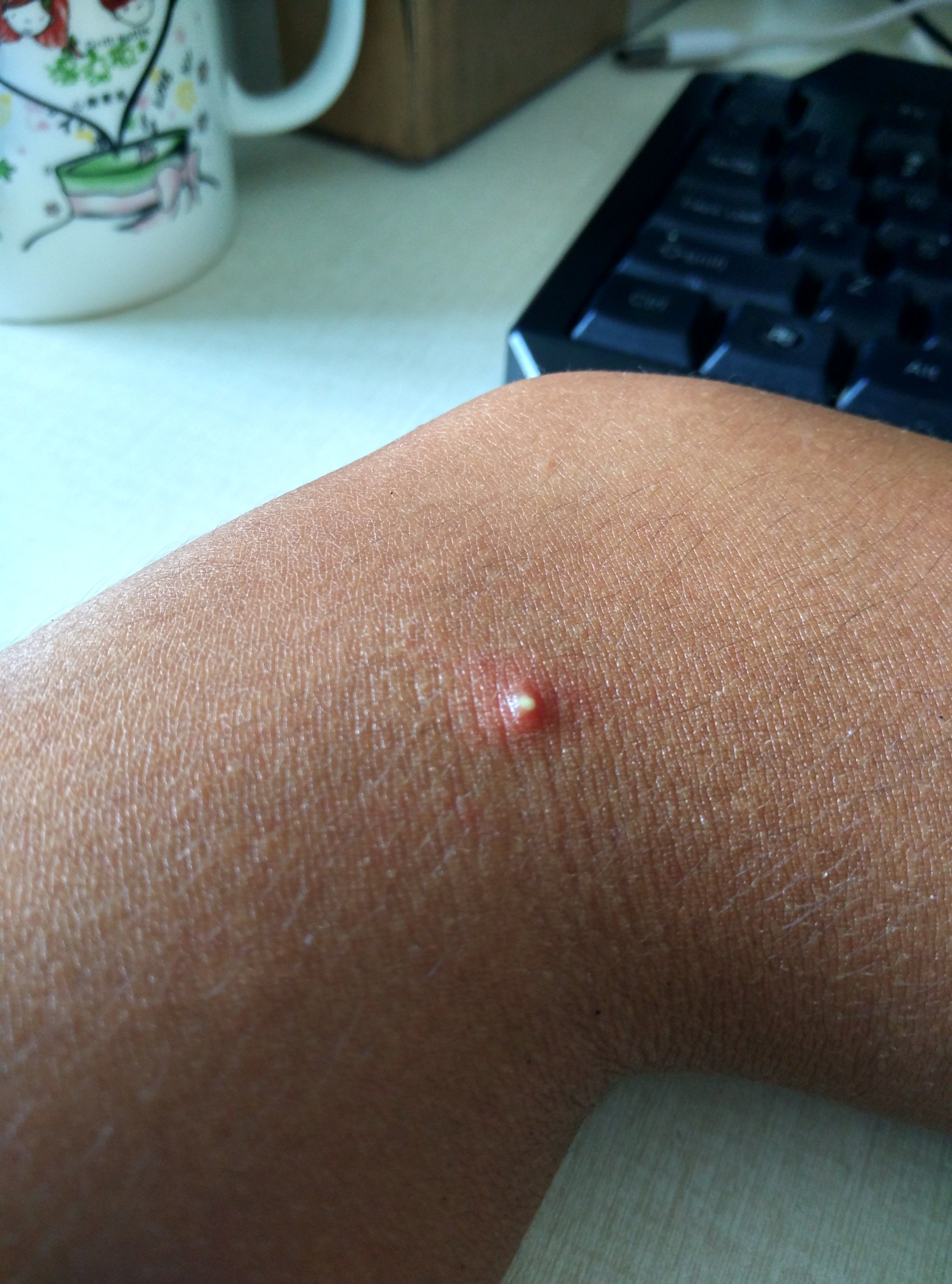 手臂上有疙瘩,不痛不痒