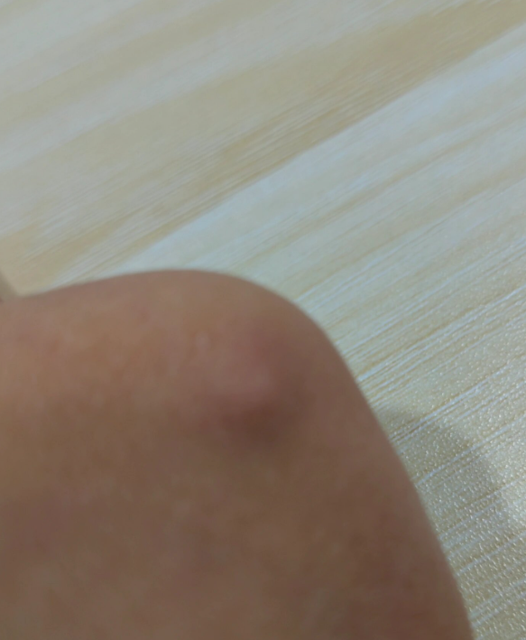 手臂上有疙瘩,不痛不痒