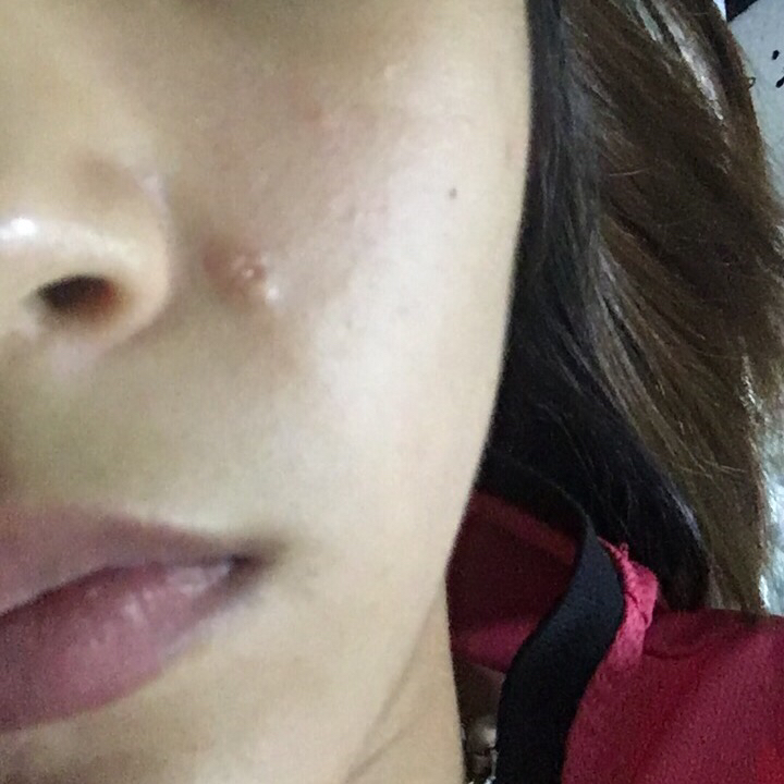 脸上长了个硬硬的疙瘩!