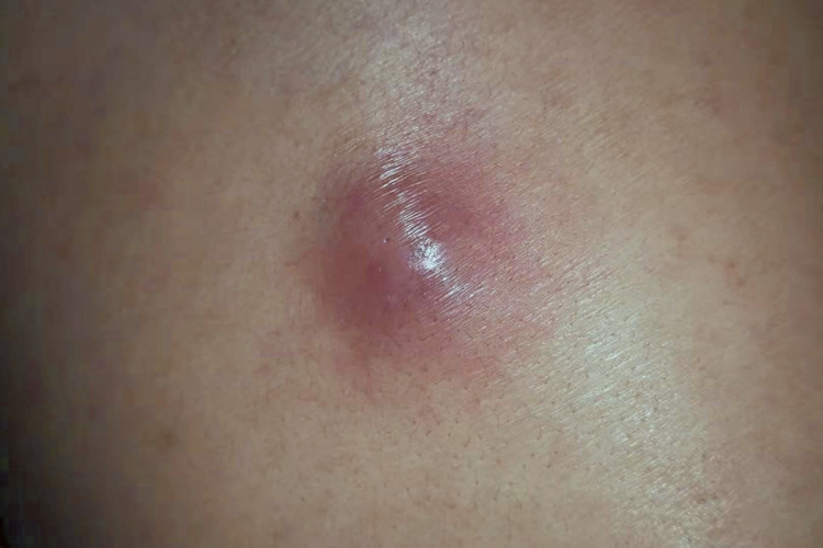 脸上长了个硬硬的疙瘩!