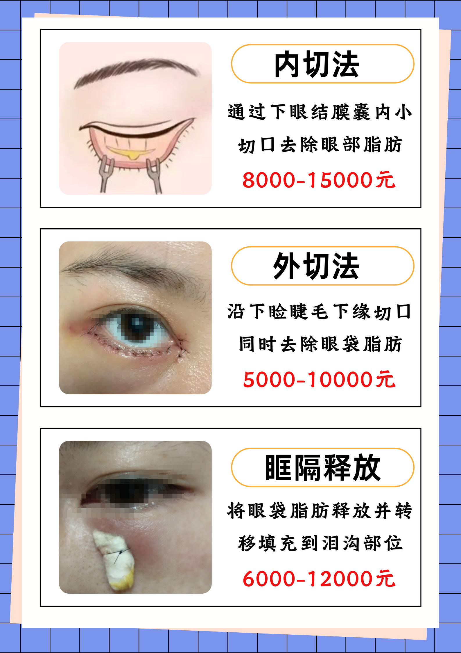 去眼袋手术安全吗