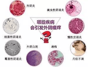 孕妇外阴瘙痒怎么缓解?