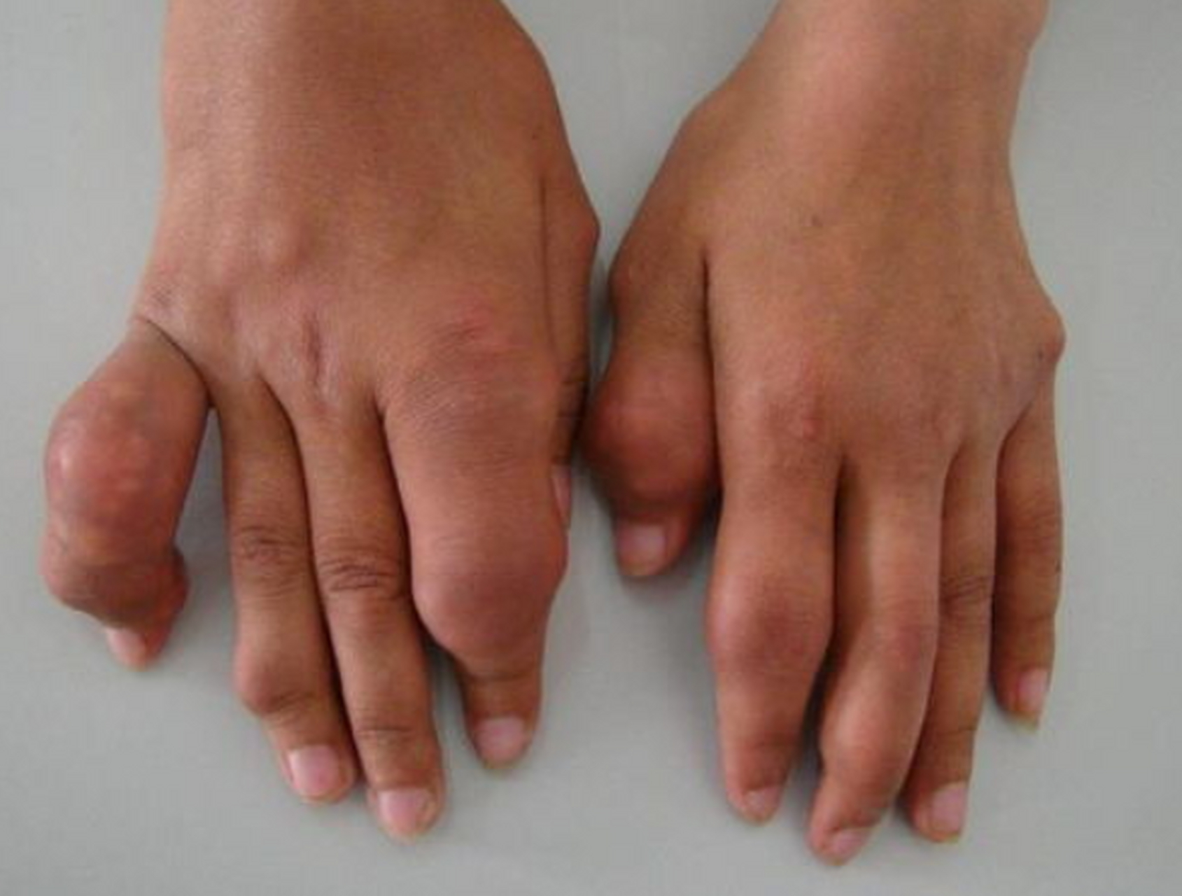 痛风的症状表现