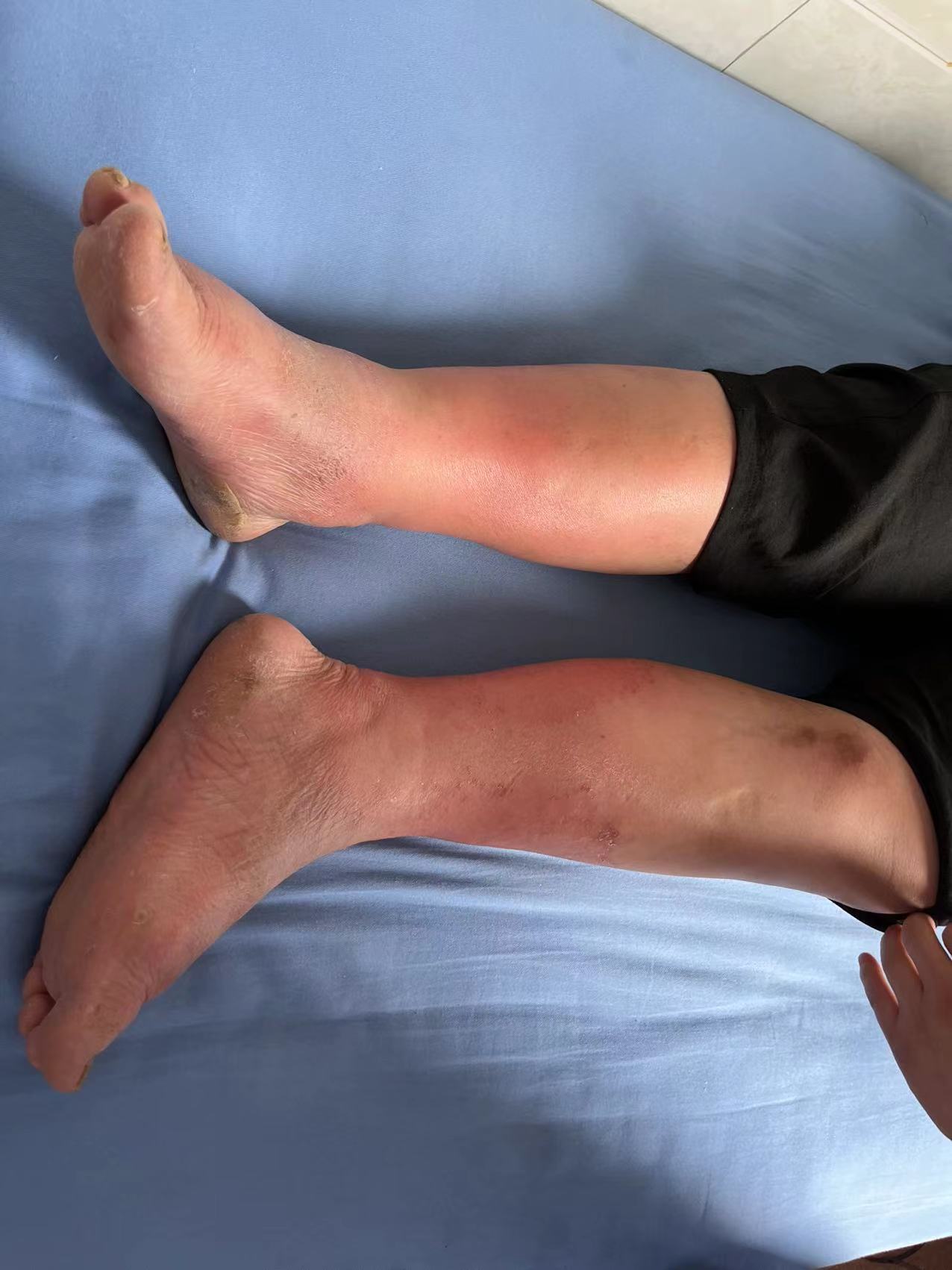 痛风的症状表现