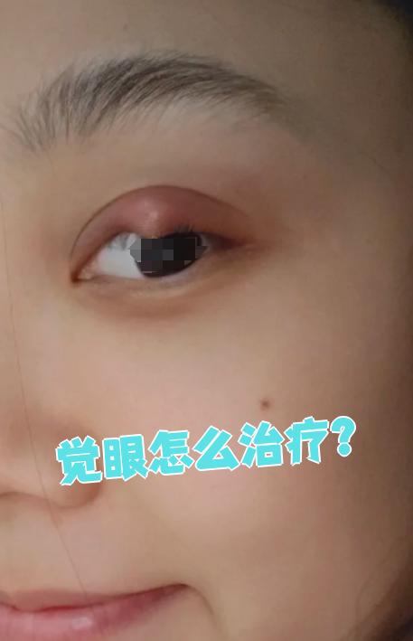 麦粒肿会传染吗