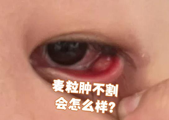 麦粒肿会传染吗