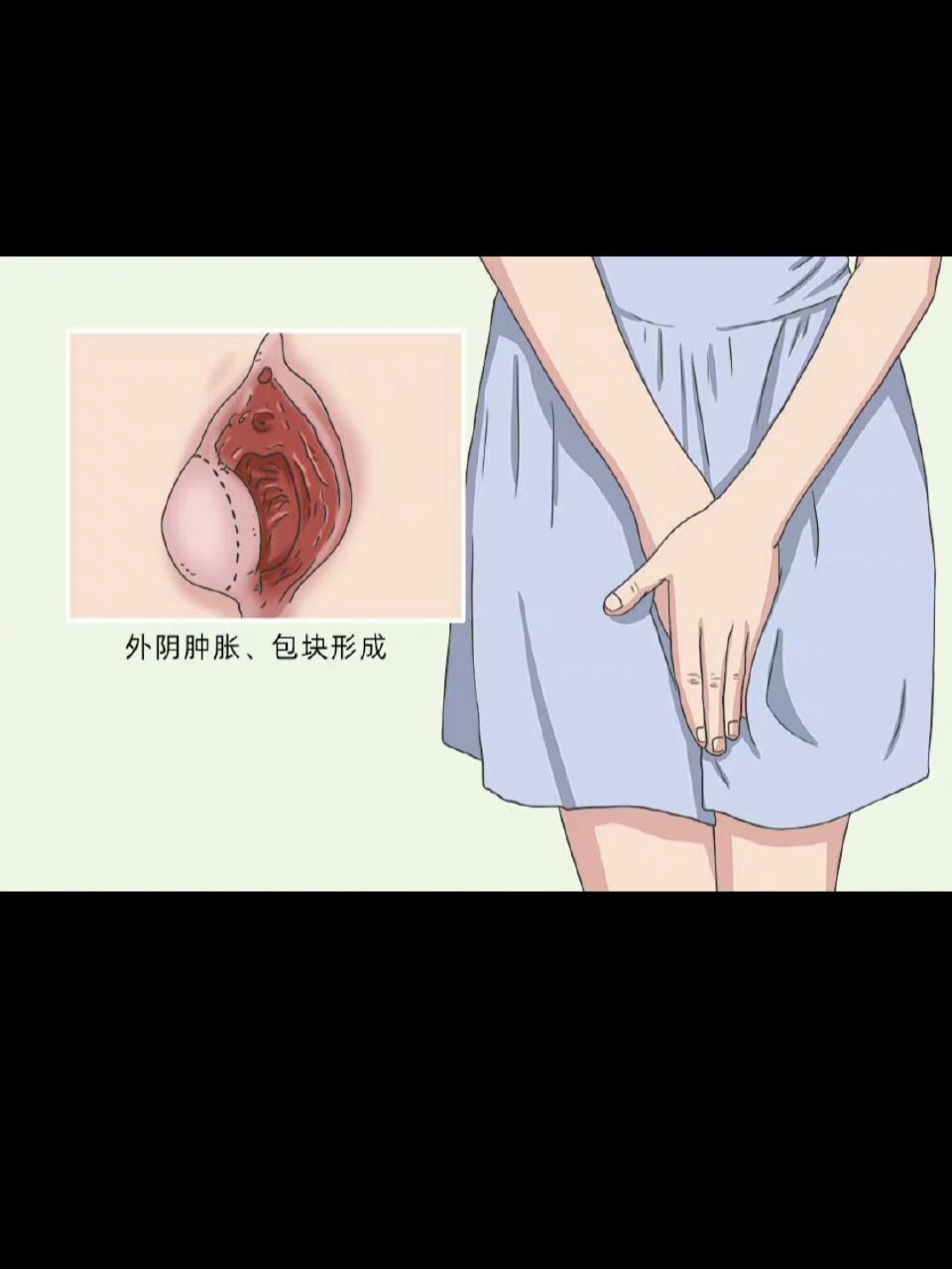 前庭大腺囊肿怎样治疗