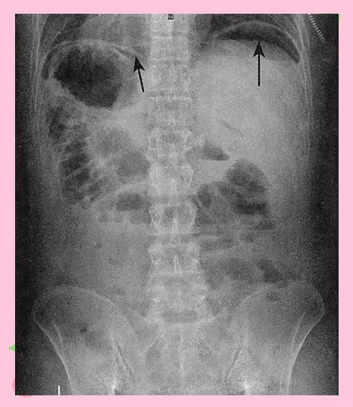 消化道穿孔是什么疾病