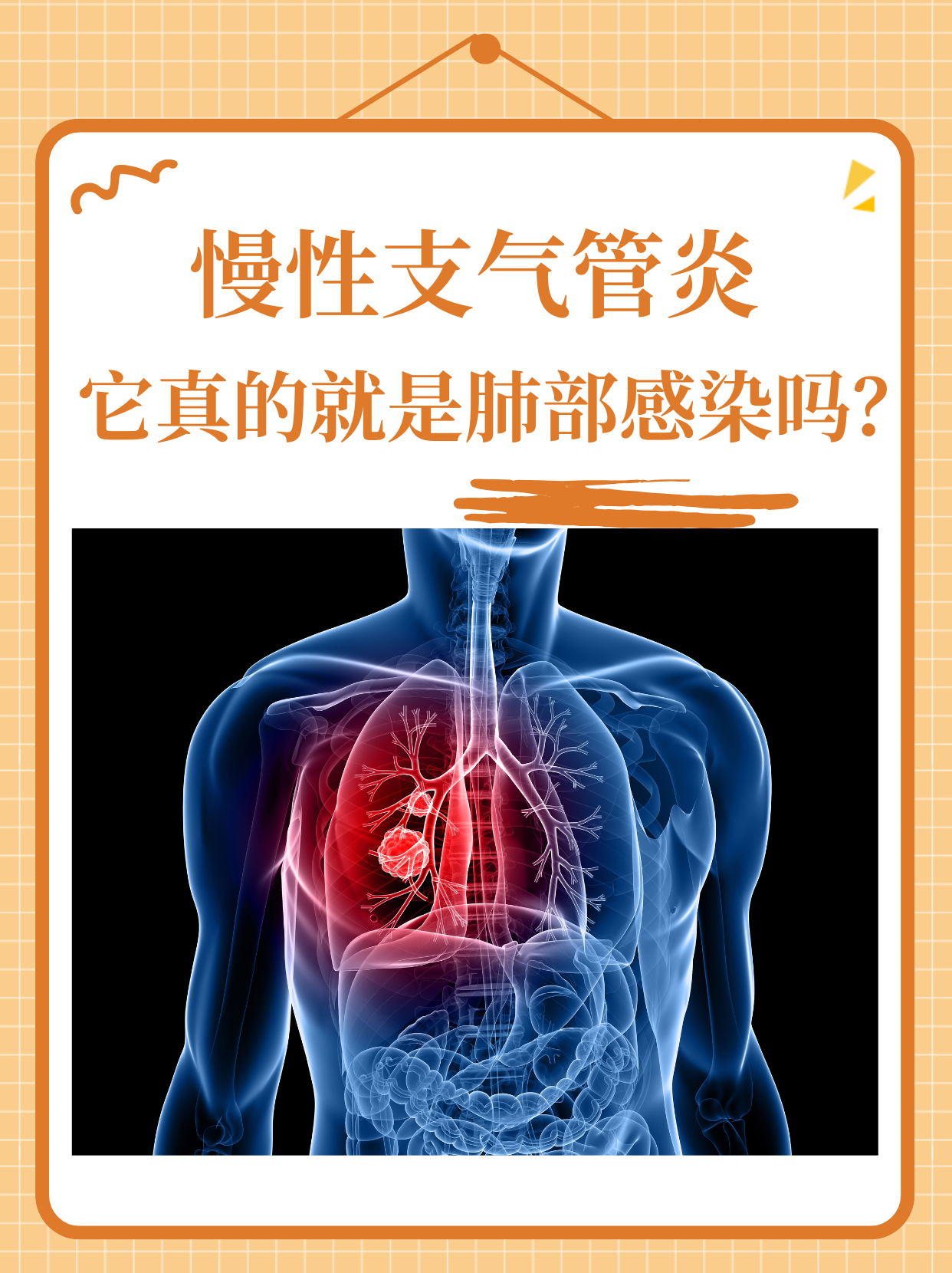 慢性支气管炎的症状和治疗方法是什么