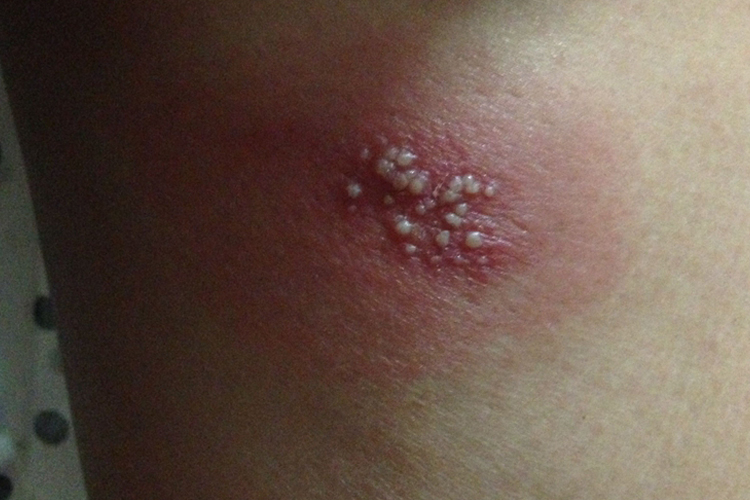 长痘三年闭合性粉刺脓包型痘痘