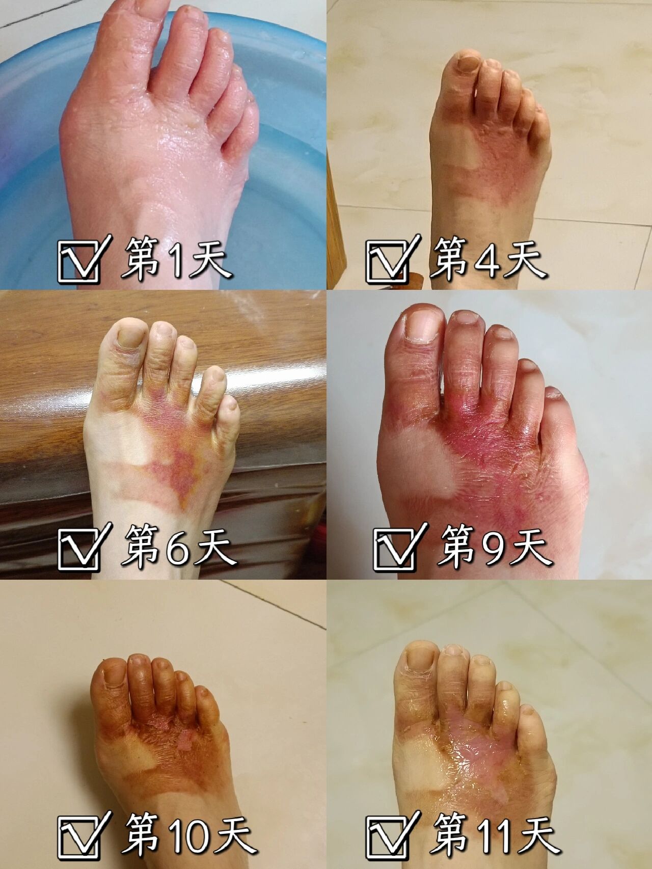 一般烫伤需要多长时间能好