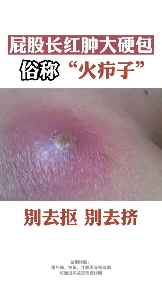 火疖子怎么办?