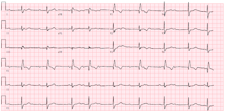 三度房室传导阻滞心电图特点