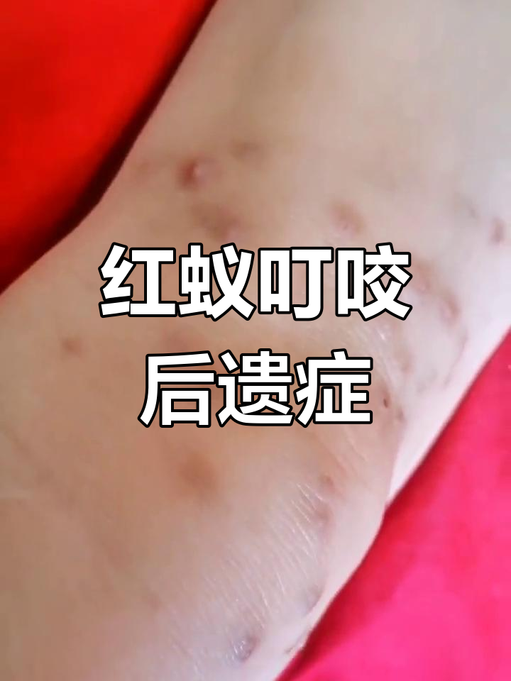 被红蚂蚁咬伤怎么办