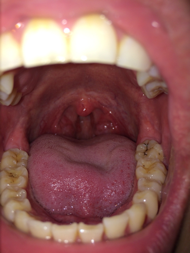 喉咙里白色的是什么东西