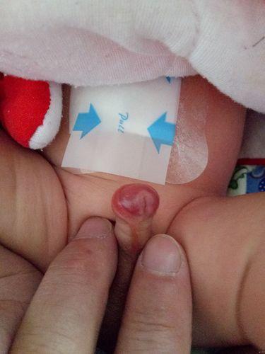 最严重的尿道管下裂图片