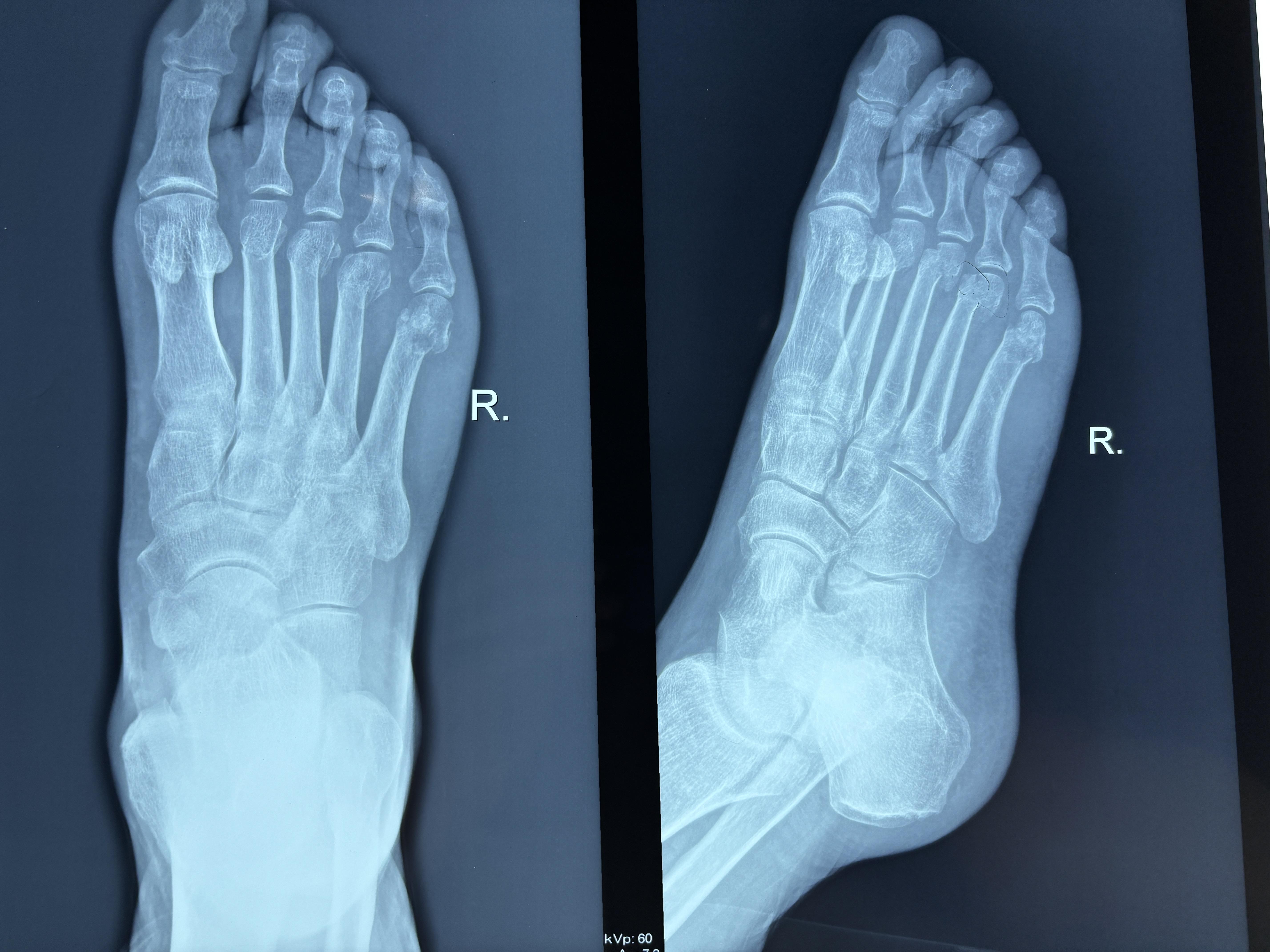 跖骨骨折愈合时间为多久