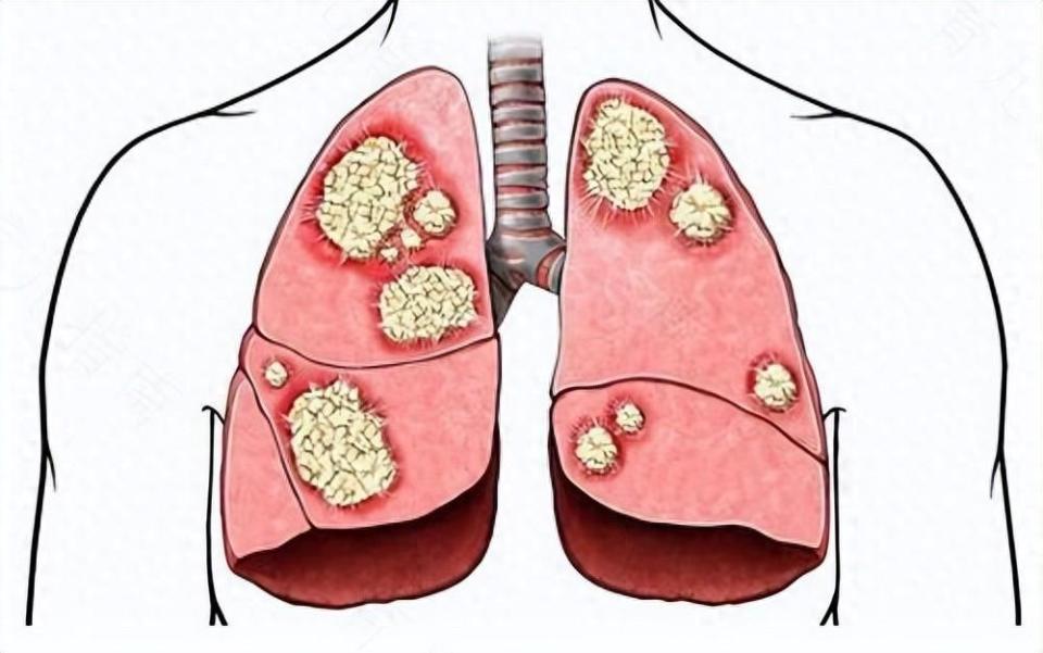 肺癌中期会出现什么症状