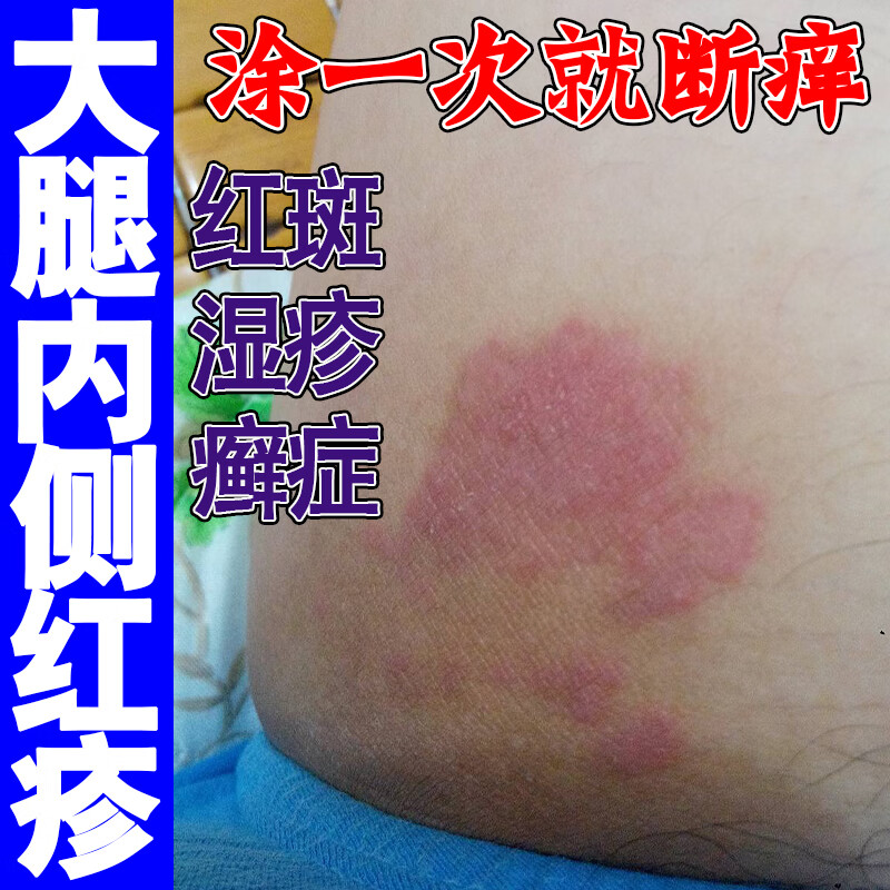 大腿内侧有红斑什么原因?