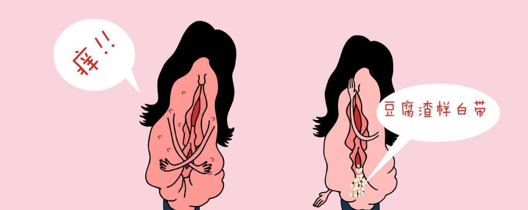 外阴瘙痒症是什么