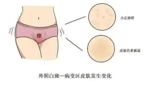外阴瘙痒症是什么