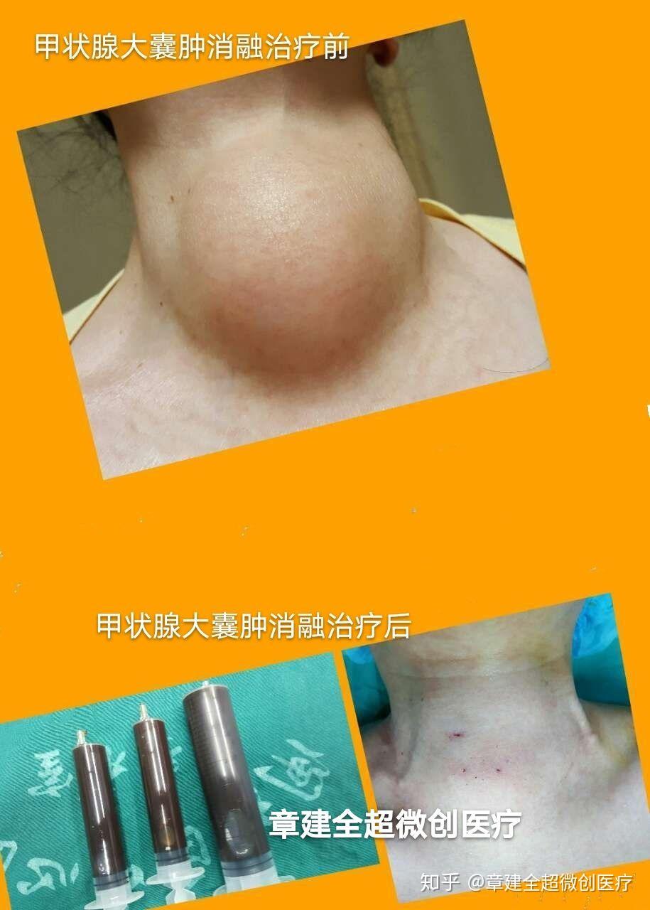 甲状腺囊肿必须做手术吗
