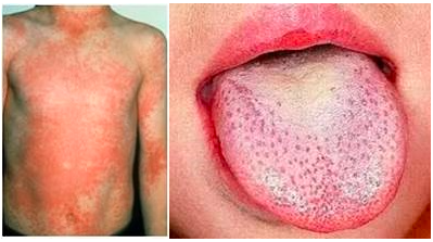 猩红热是什么病