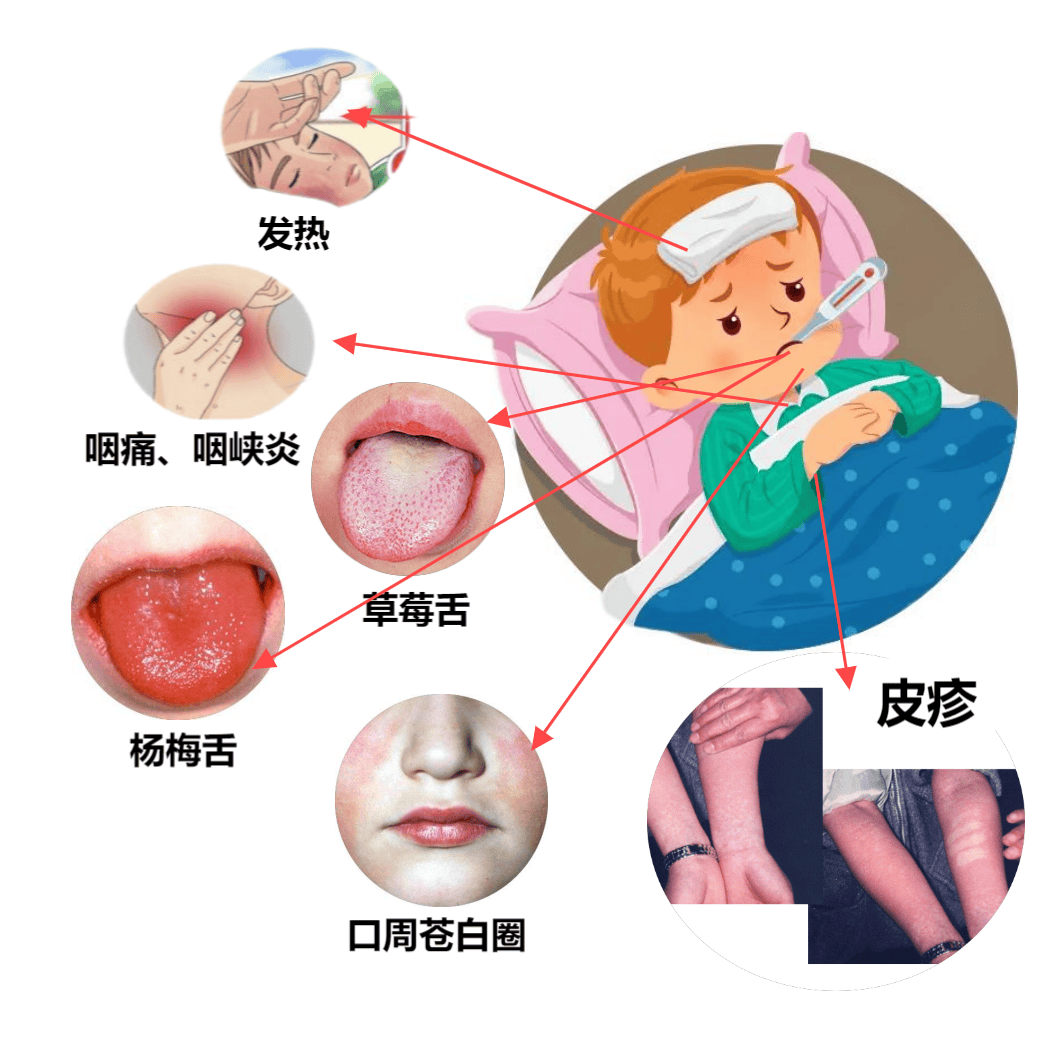 猩红热是什么病