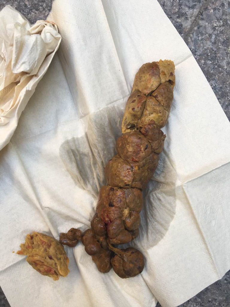 大便后只有纸上有血,不痛不痒