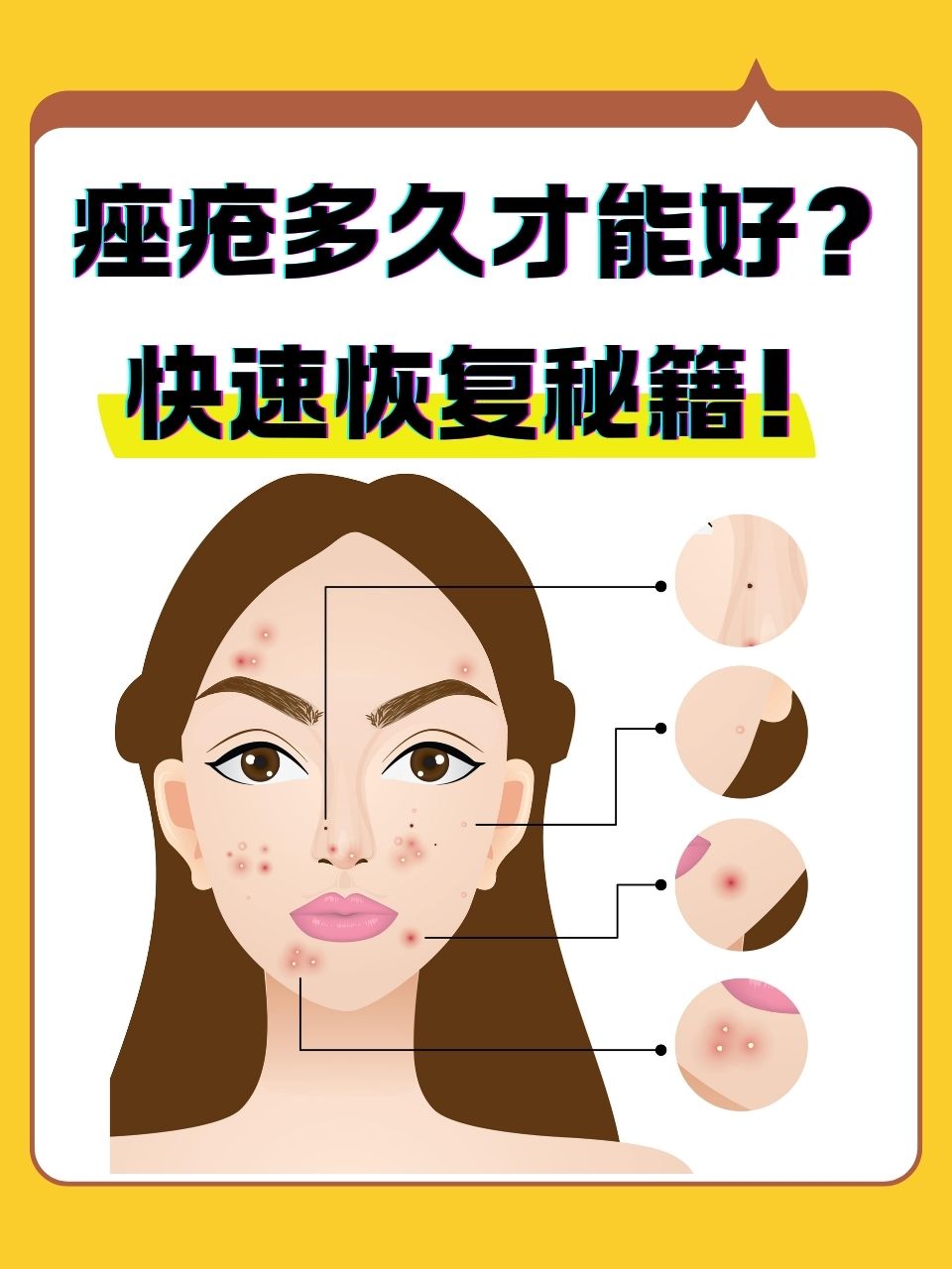 脸上起痤疮怎么办