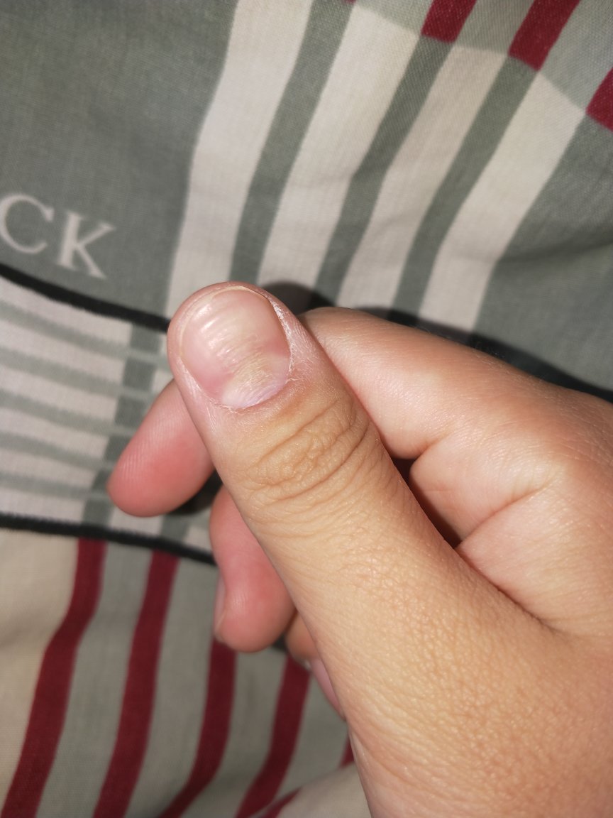 大拇指指甲凹凸不平怎么办