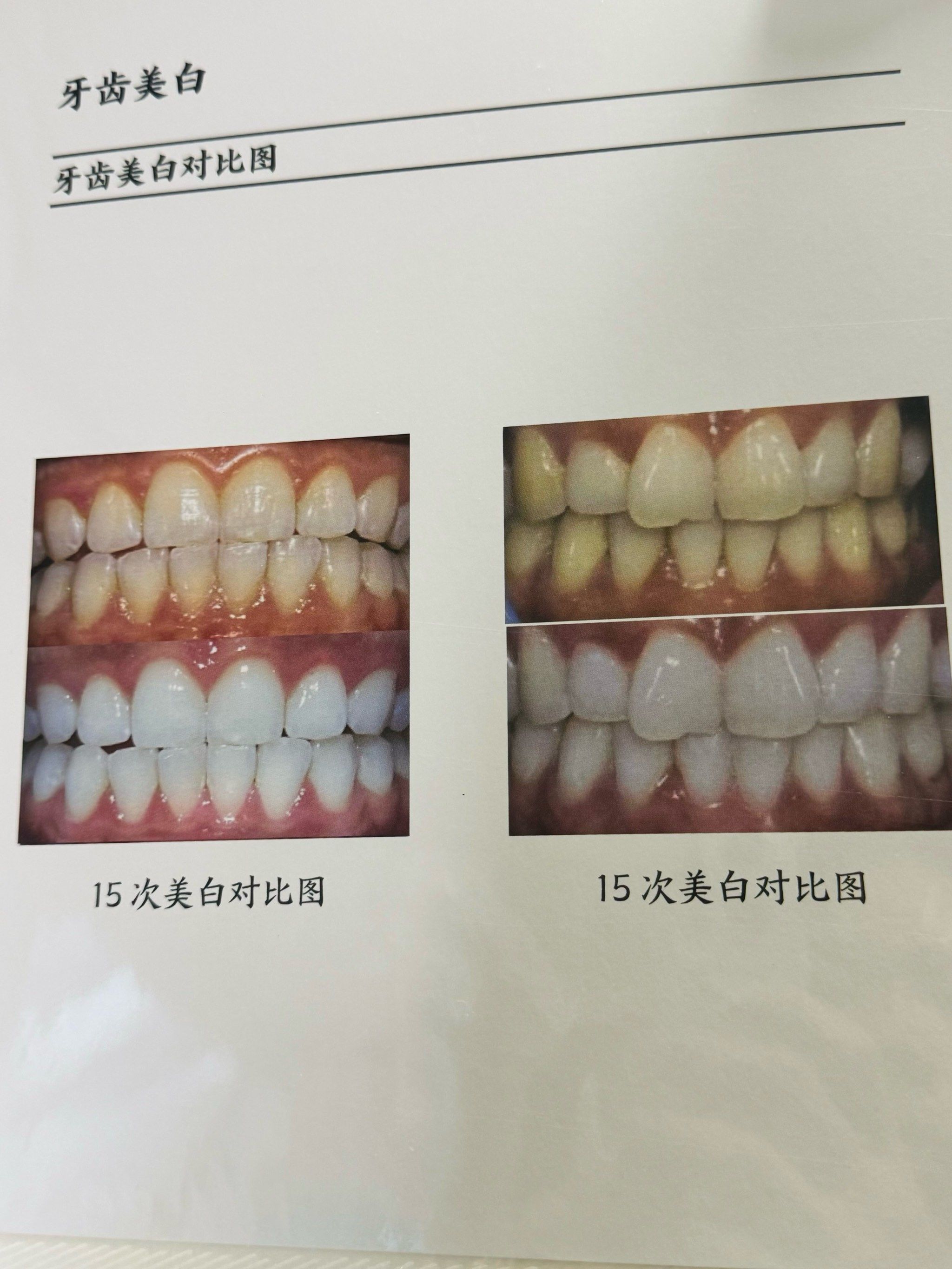 冷光美白牙齿能保持多久?