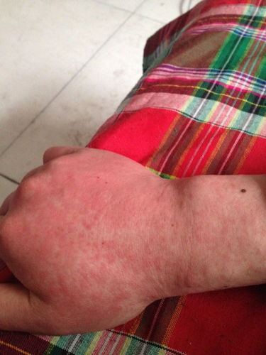 手上起了红色的小点点.