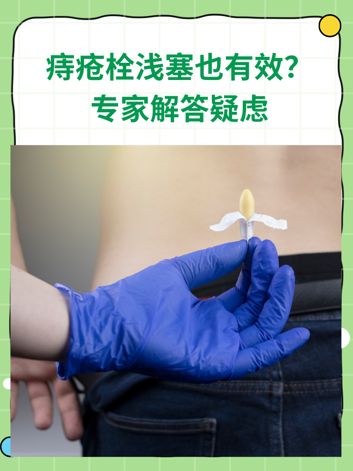 痔疮栓要塞多久?