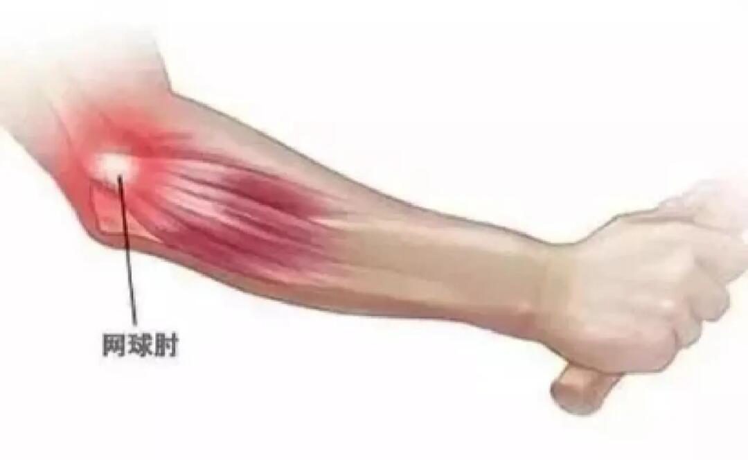 网球肘怎么治疗好得快