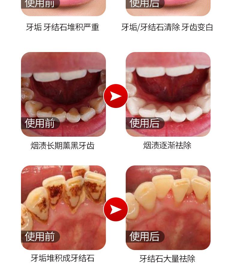 牙缝有黑渍怎么去除