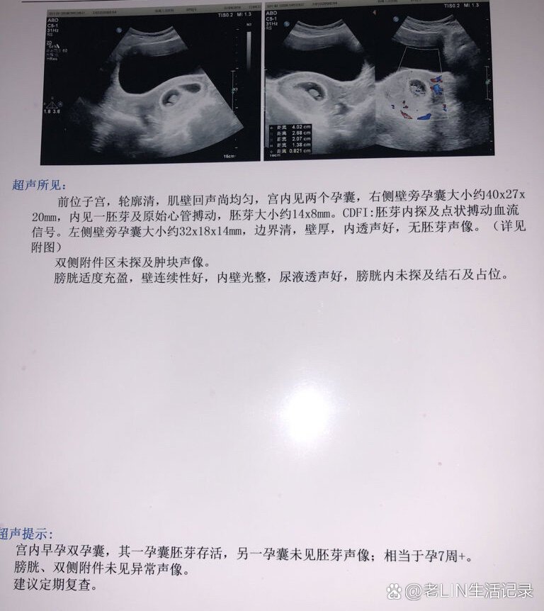 多胎妊娠是什么意思