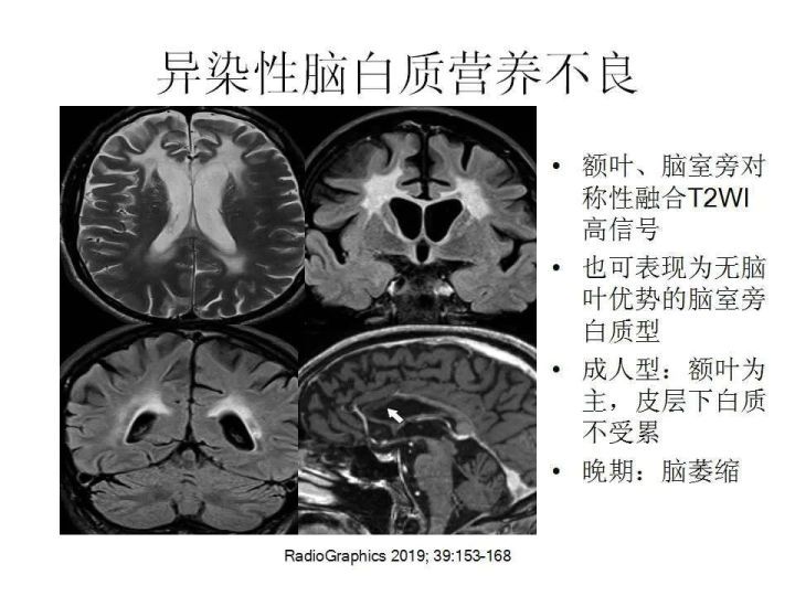 脑白质营养不良是怎么回事