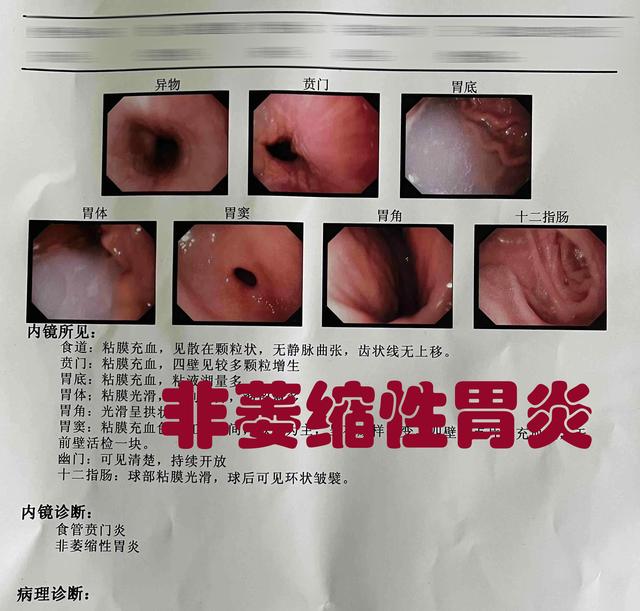 什么是非萎缩性胃炎?