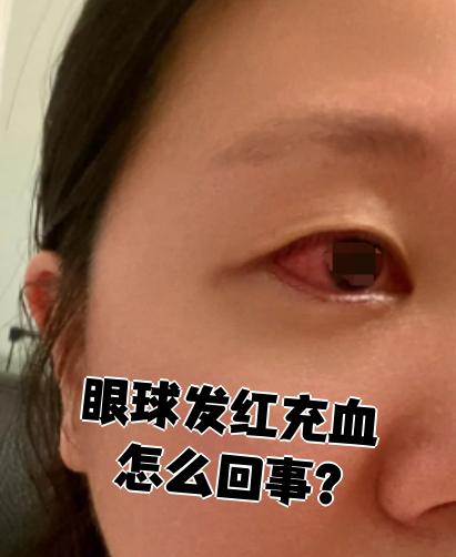 眼球出血是怎么回事