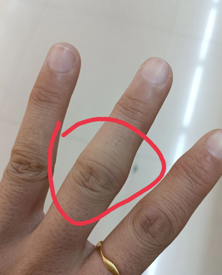 中指关节疼是什么原因