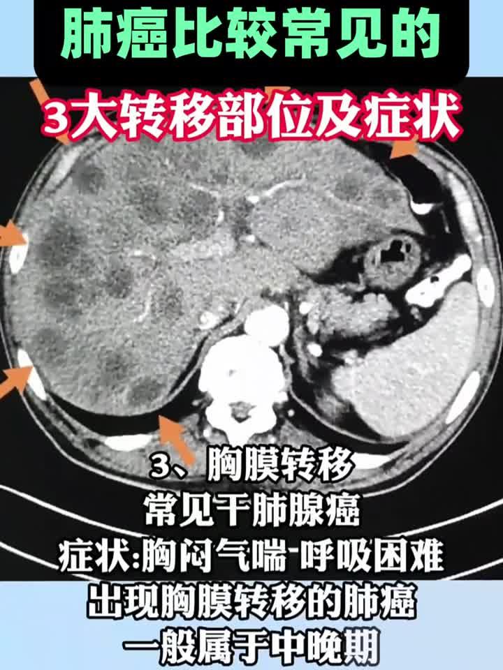 肺癌转移途径是什么