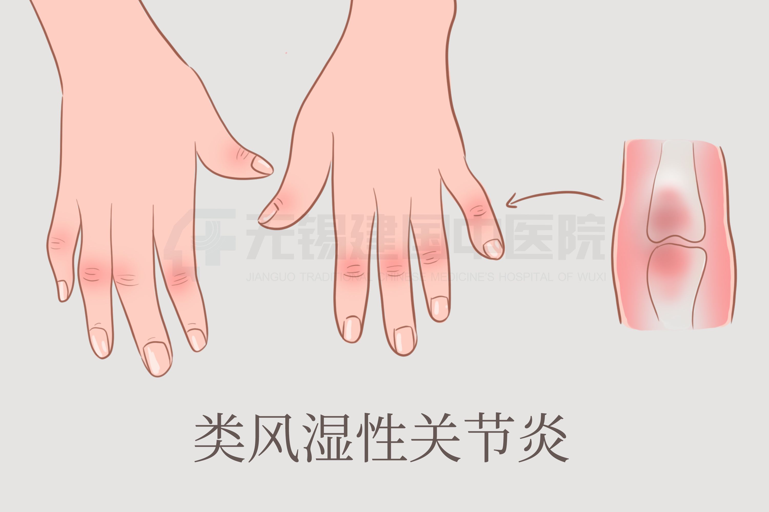 类风湿关节炎是什么