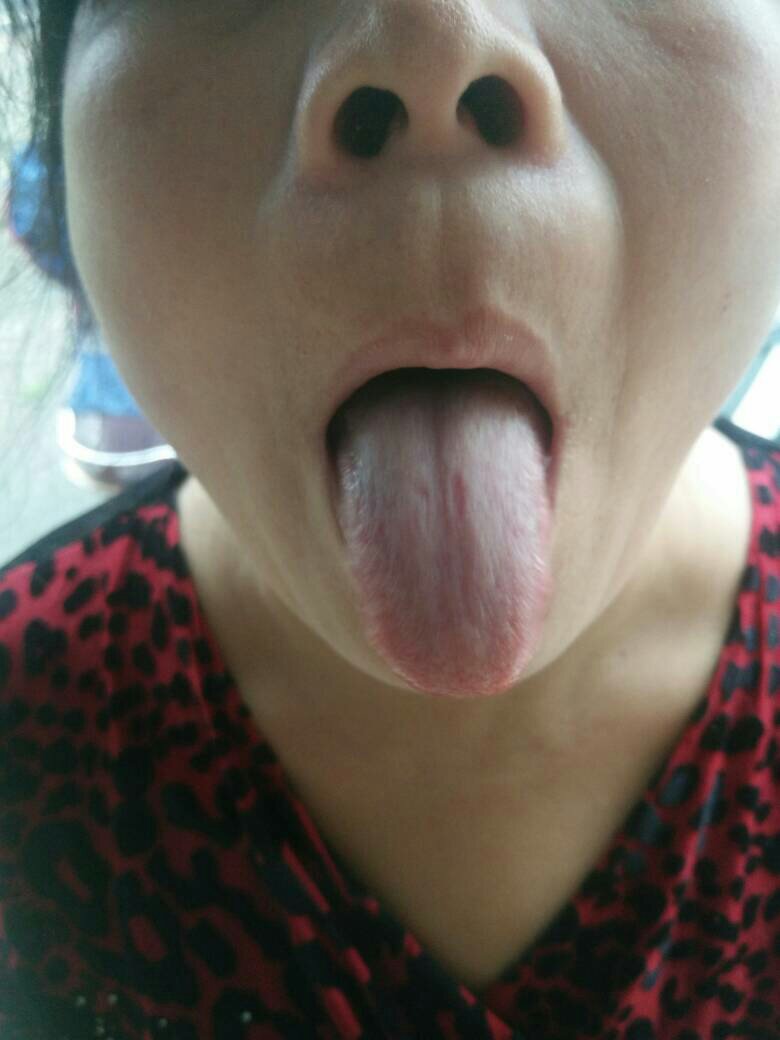 我的舌头怎么这样子了?