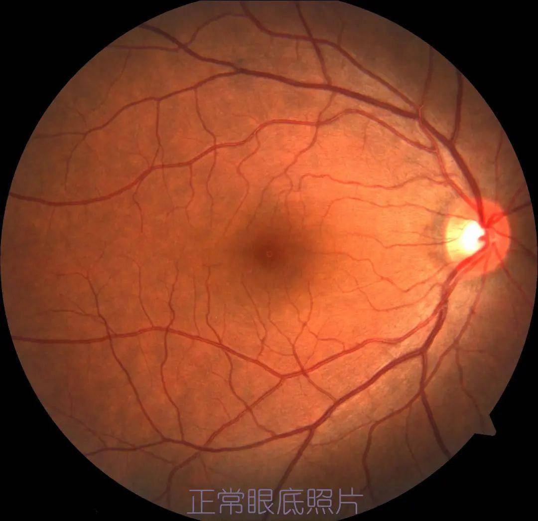 眼底检查都有哪些