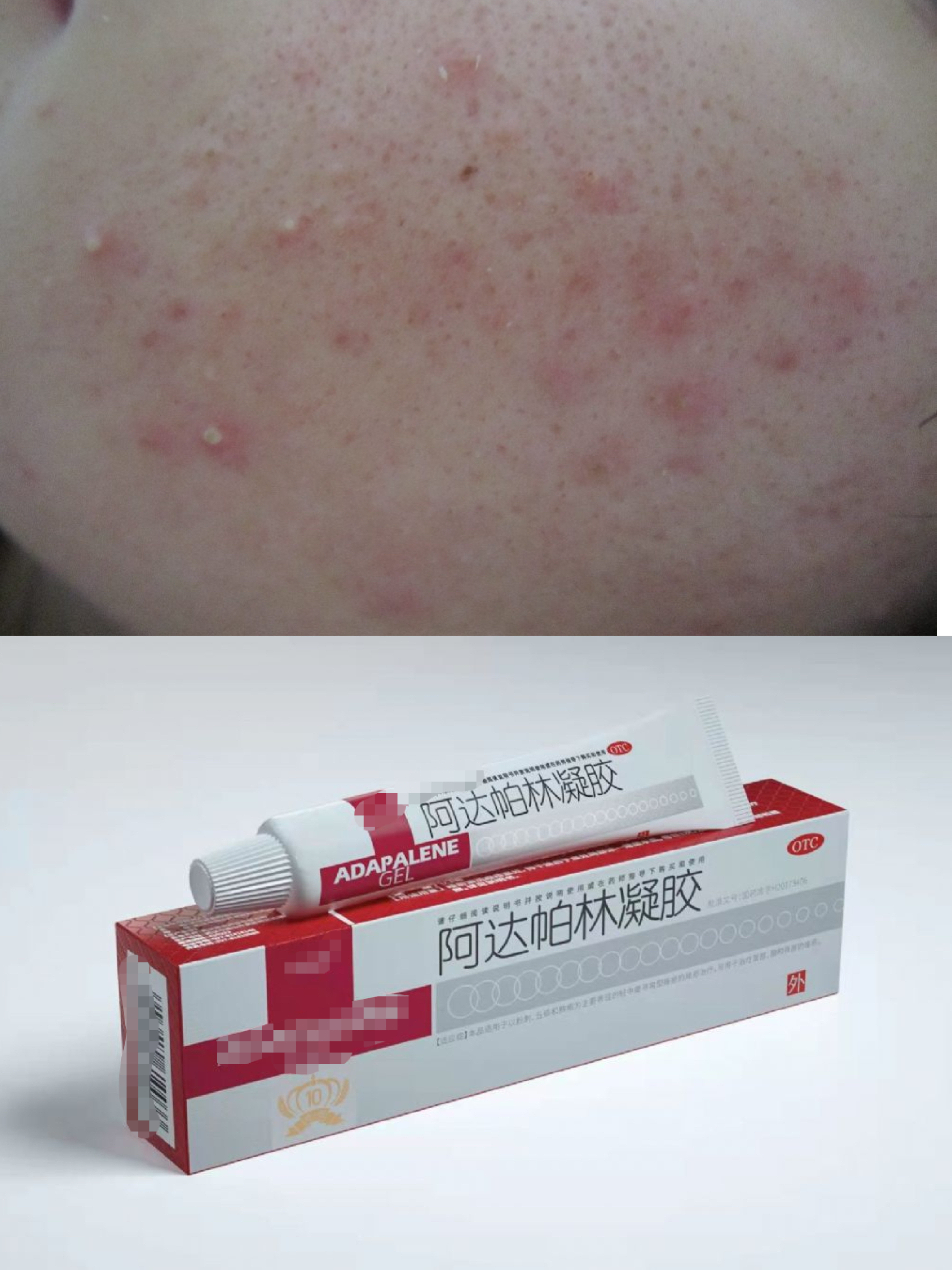 维生素A酸乳膏真的能增厚脸部角质层